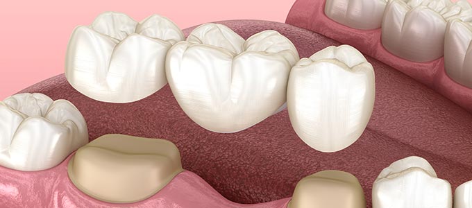 Dental Crowns and Bridges Specialist Near Me in Norwalk, CT Dental Crowns and Bridges Specialist Near Me in Norwalk, CT