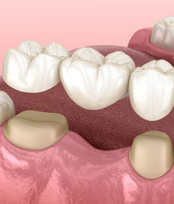 Dental Crowns and Dental Bridges Near Me in Norwalk, CT