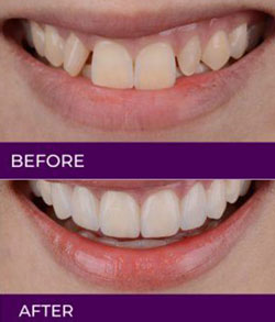 Before and After Gallery - Daniel Dental Studio in Norwalk, CT