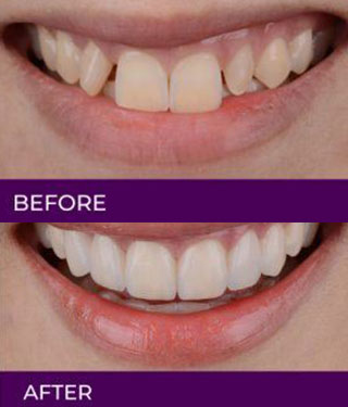 Before and After Gallery - Daniel Dental Studio in Norwalk, CT