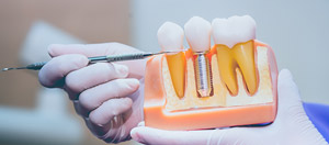 Dental Implants Specialist Near Me in Norwalk, CT