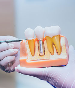 Dental Implants Near Me in Norwalk, CT