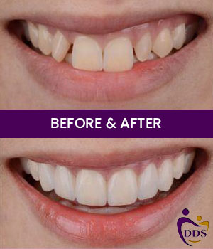 Before and After Photos of Daniel Dental Studio in Norwalk, CT