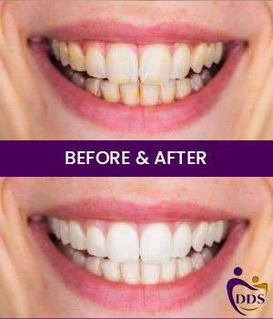 Before and After Photos of Daniel Dental Studio in Norwalk, CT