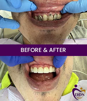 Before and After Photos of Daniel Dental Studio in Norwalk, CT