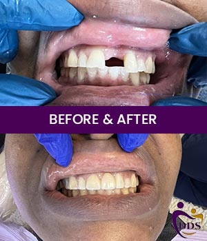 Before and After Photos of Daniel Dental Studio in Norwalk, CT