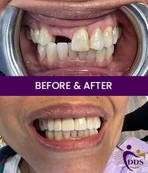 Before and After Photos of Daniel Dental Studio in Norwalk, CT