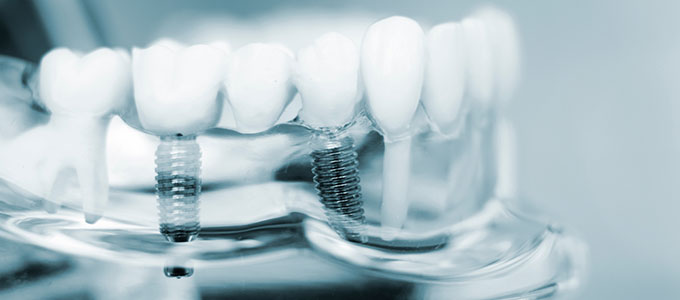 Cost of Dental Implants Near Me in Norwalk CT