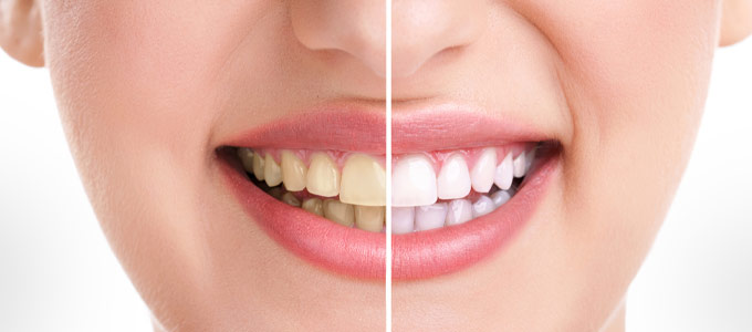 Cost of Dental Whitening Near Me in Norwalk, CT