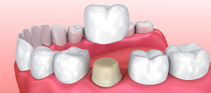 How Much Does New Dental Crown Near Me Cost in Norwalk, CT How Much Does New Dental Crown Near Me Cost in Norwalk, CT